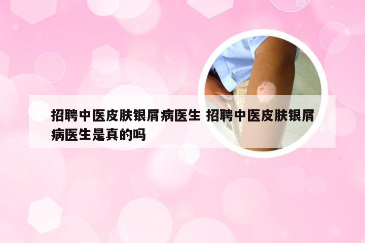 招聘中医皮肤银屑病医生 招聘中医皮肤银屑病医生是真的吗