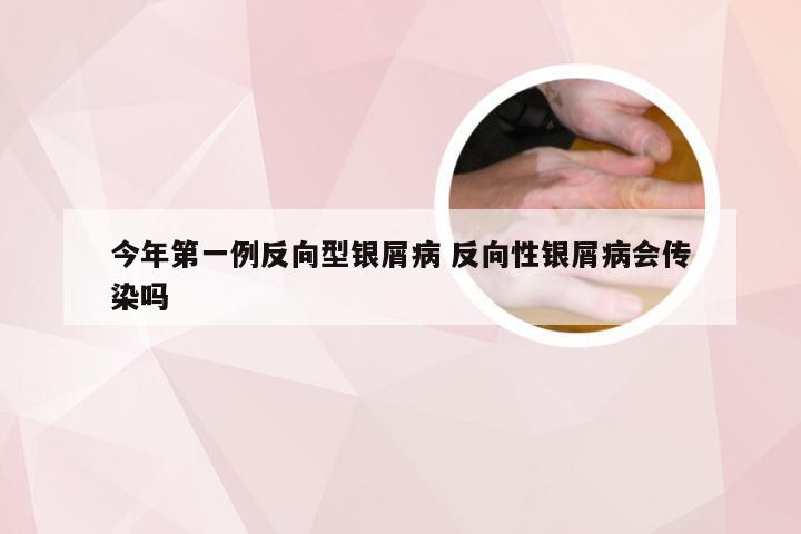 今年第一例反向型银屑病 反向性银屑病会传染吗