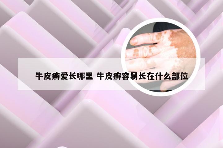 牛皮癣爱长哪里 牛皮癣容易长在什么部位