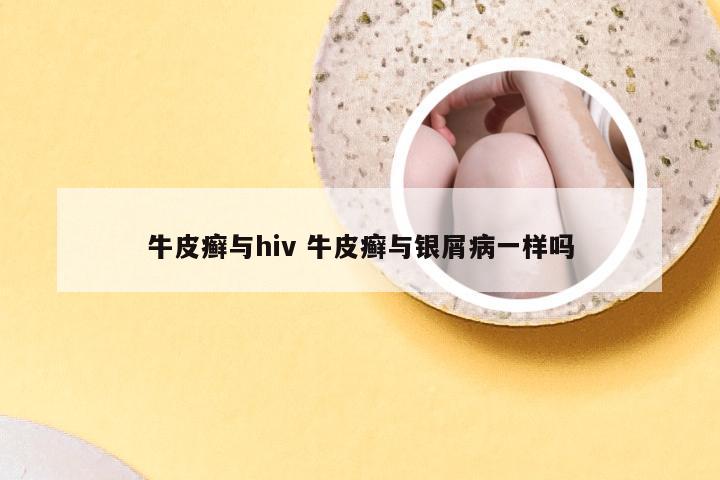 牛皮癣与hiv 牛皮癣与银屑病一样吗