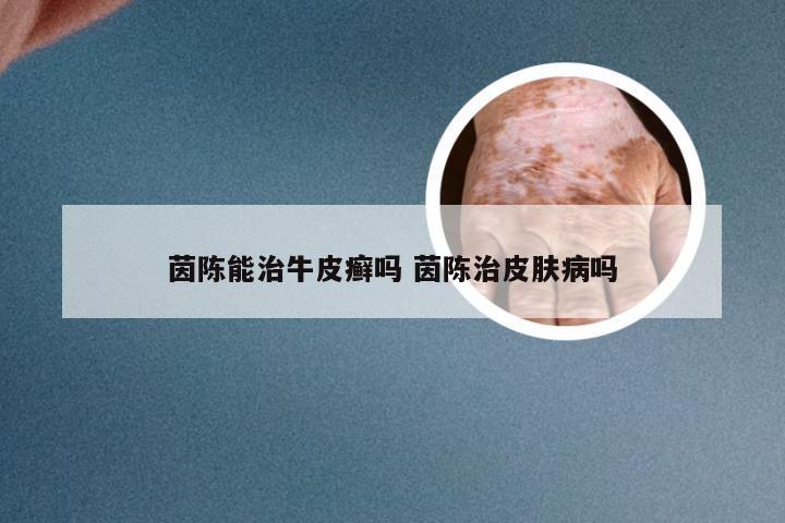 茵陈能治牛皮癣吗 茵陈治皮肤病吗