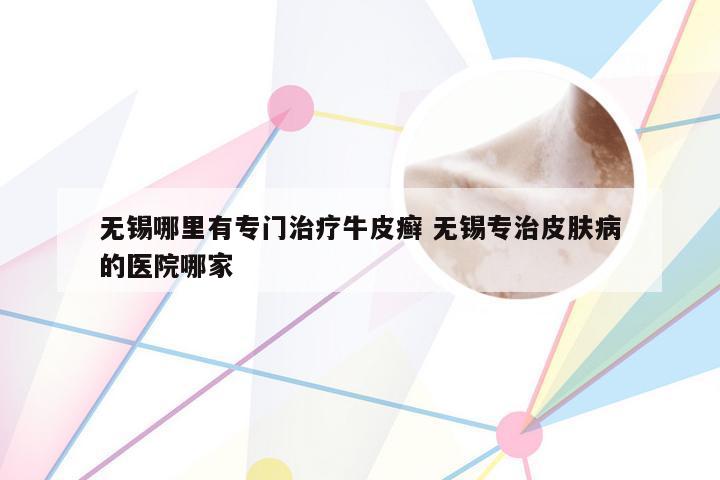 无锡哪里有专门治疗牛皮癣 无锡专治皮肤病的医院哪家