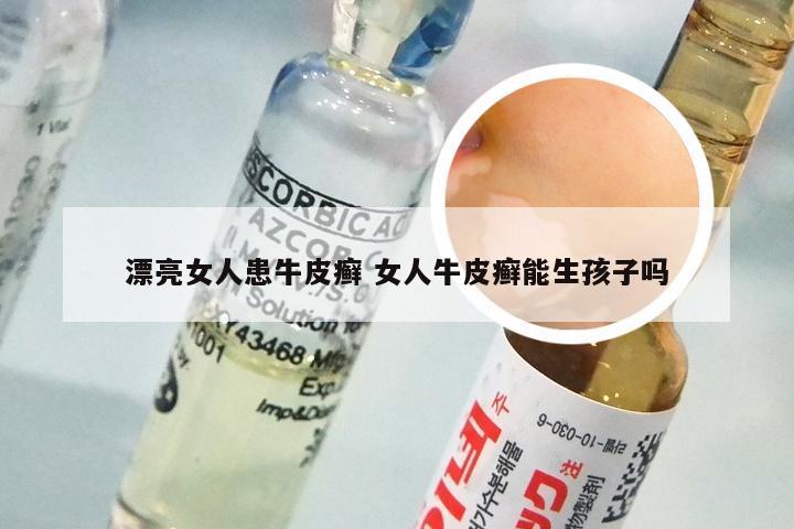 漂亮女人患牛皮癣 女人牛皮癣能生孩子吗