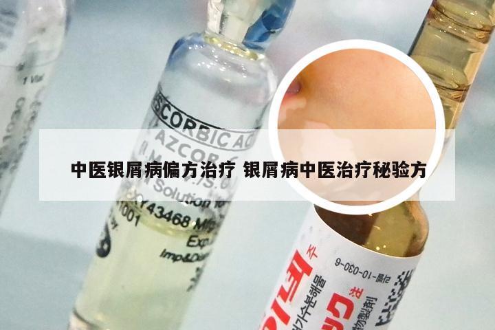 中医银屑病偏方治疗 银屑病中医治疗秘验方