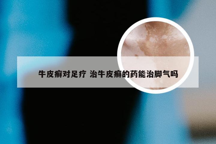 牛皮癣对足疗 治牛皮癣的药能治脚气吗