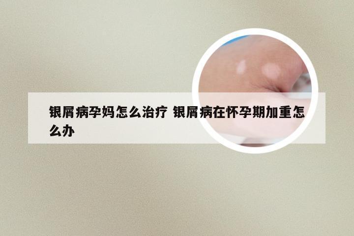 银屑病孕妈怎么治疗 银屑病在怀孕期加重怎么办
