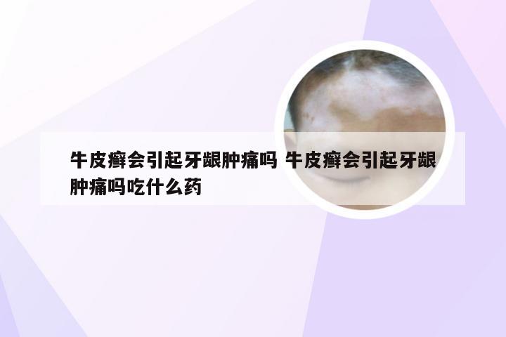 牛皮癣会引起牙龈肿痛吗 牛皮癣会引起牙龈肿痛吗吃什么药