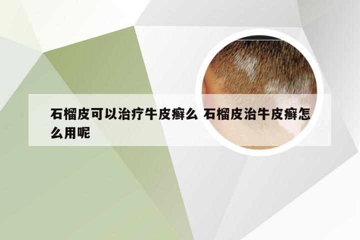 石榴皮可以治疗牛皮癣么 石榴皮治牛皮癣怎么用呢
