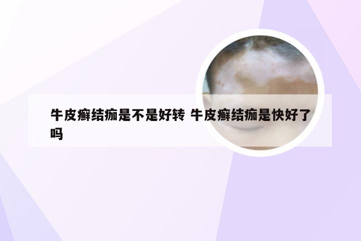 牛皮癣结痂是不是好转 牛皮癣结痂是快好了吗