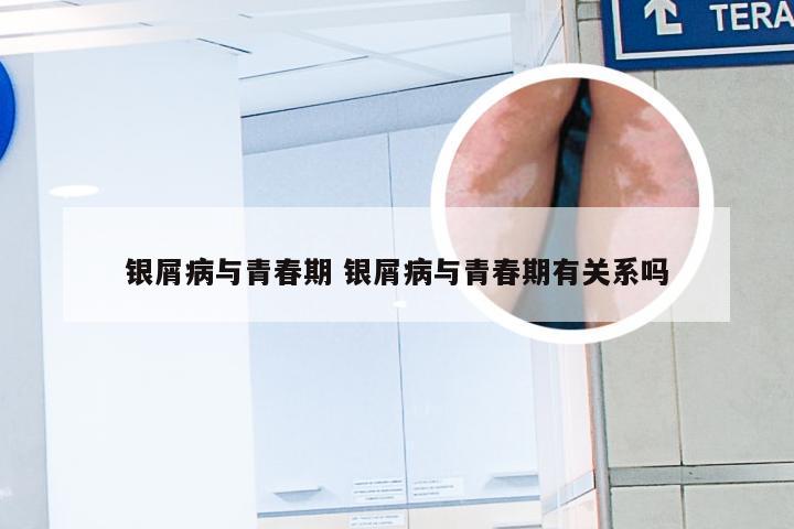 银屑病与青春期 银屑病与青春期有关系吗