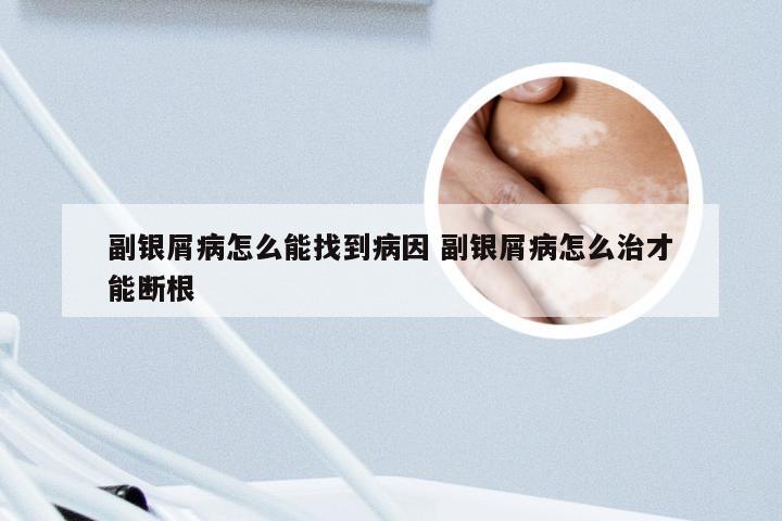副银屑病怎么能找到病因 副银屑病怎么治才能断根
