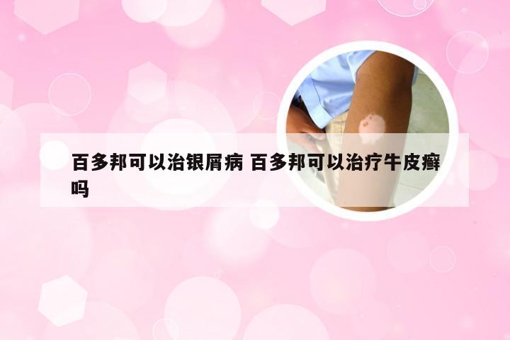 百多邦可以治银屑病 百多邦可以治疗牛皮癣吗