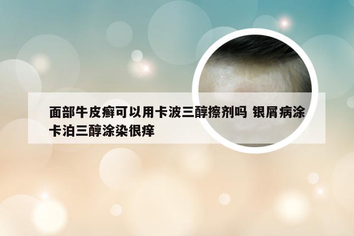 面部牛皮癣可以用卡波三醇擦剂吗 银屑病涂卡泊三醇涂染很痒