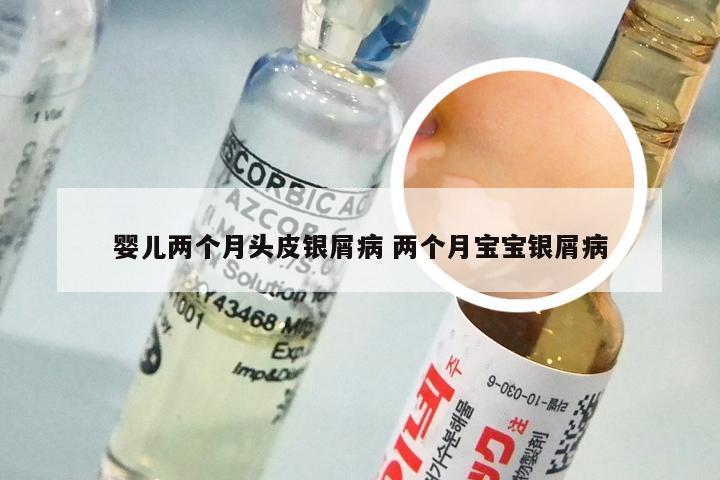 婴儿两个月头皮银屑病 两个月宝宝银屑病