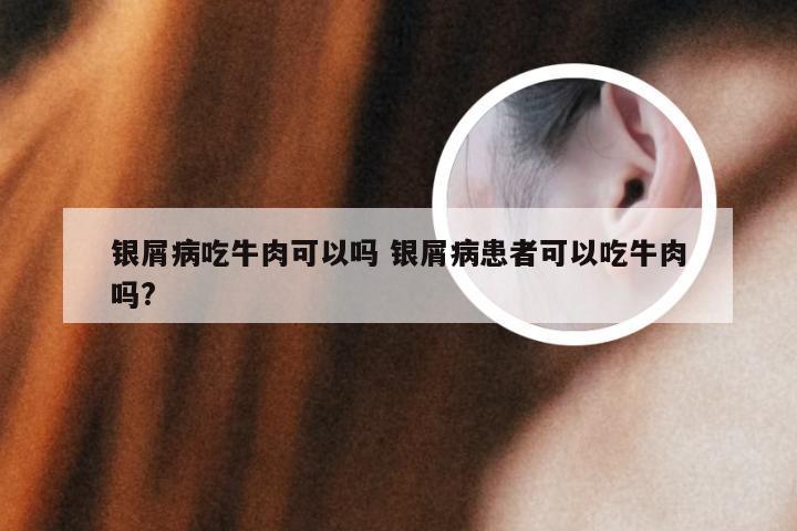 银屑病吃牛肉可以吗 银屑病患者可以吃牛肉吗?