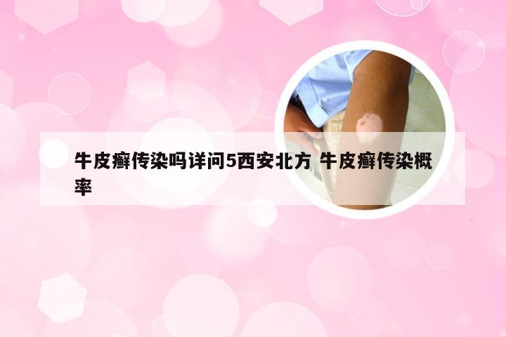牛皮癣传染吗详问5西安北方 牛皮癣传染概率