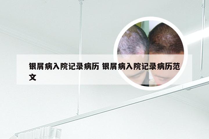 银屑病入院记录病历 银屑病入院记录病历范文