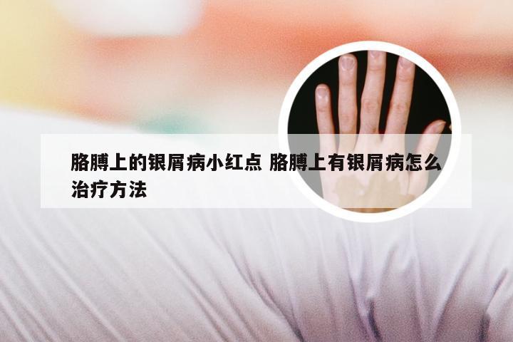 胳膊上的银屑病小红点 胳膊上有银屑病怎么治疗方法