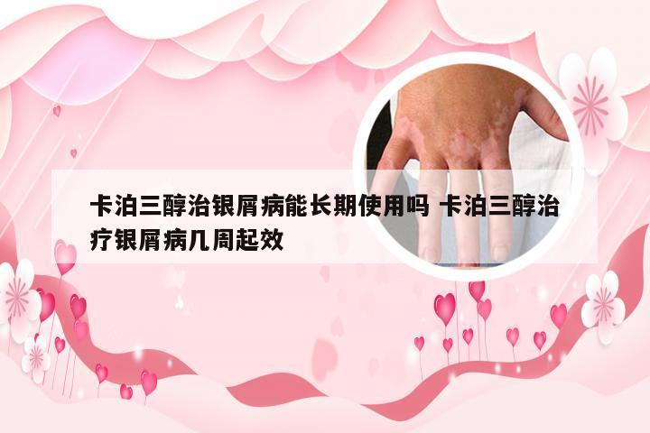卡泊三醇治银屑病能长期使用吗 卡泊三醇治疗银屑病几周起效