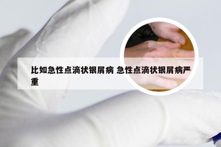 比如急性点滴状银屑病 急性点滴状银屑病严重