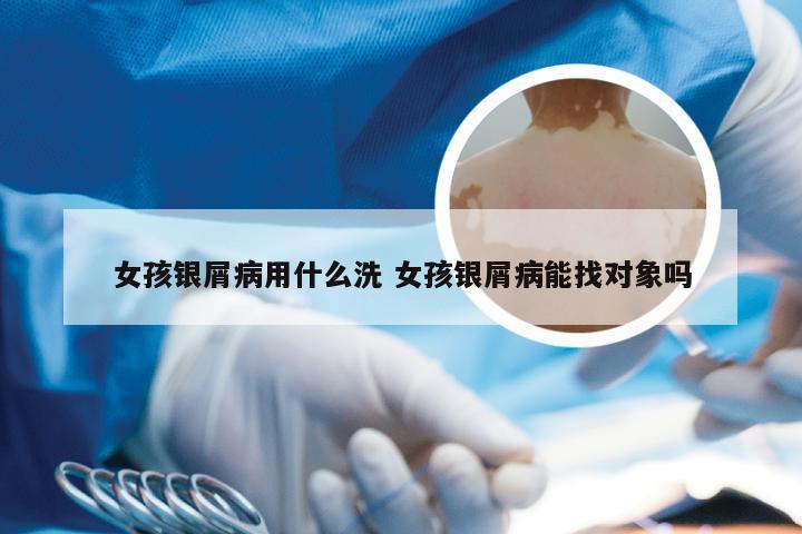 女孩银屑病用什么洗 女孩银屑病能找对象吗