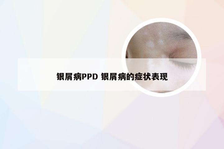 银屑病PPD 银屑病的症状表现
