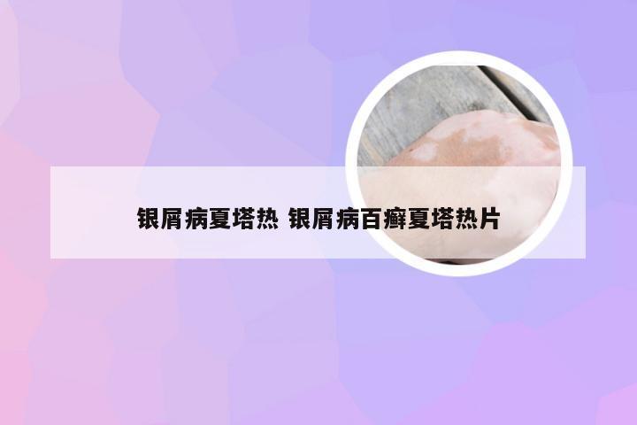 银屑病夏塔热 银屑病百癣夏塔热片