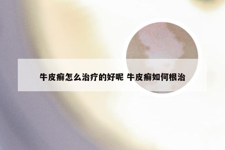 牛皮癣怎么治疗的好呢 牛皮癣如何根治