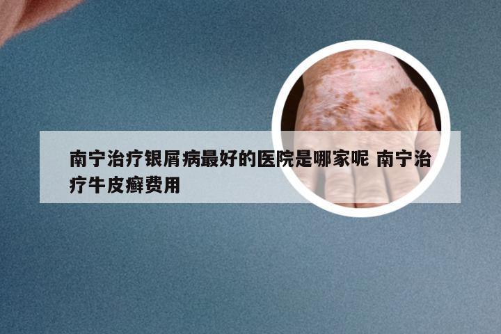 南宁治疗银屑病最好的医院是哪家呢 南宁治疗牛皮癣费用