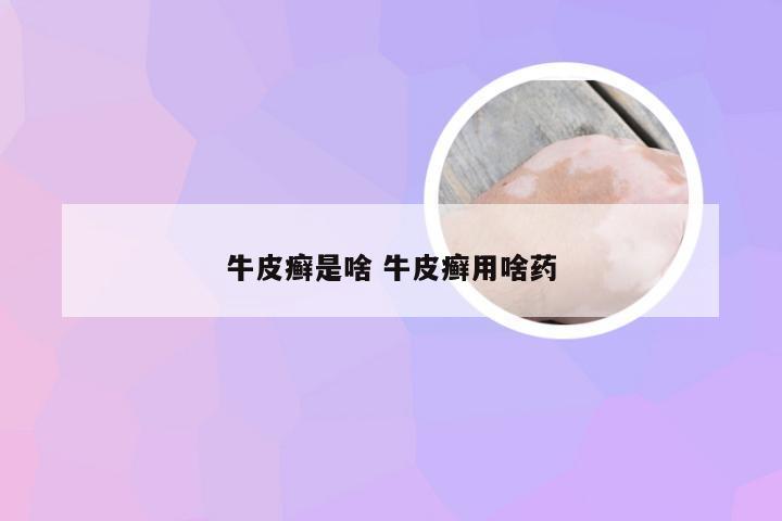 牛皮癣是啥 牛皮癣用啥药