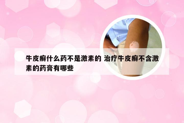 牛皮癣什么药不是激素的 治疗牛皮癣不含激素的药膏有哪些