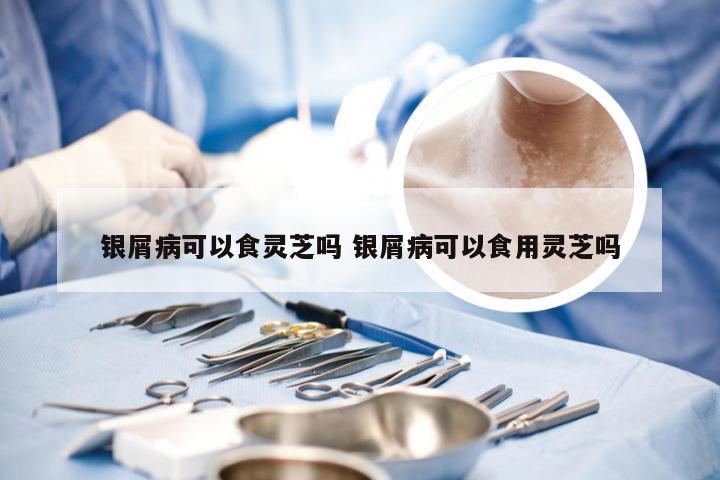 银屑病可以食灵芝吗 银屑病可以食用灵芝吗