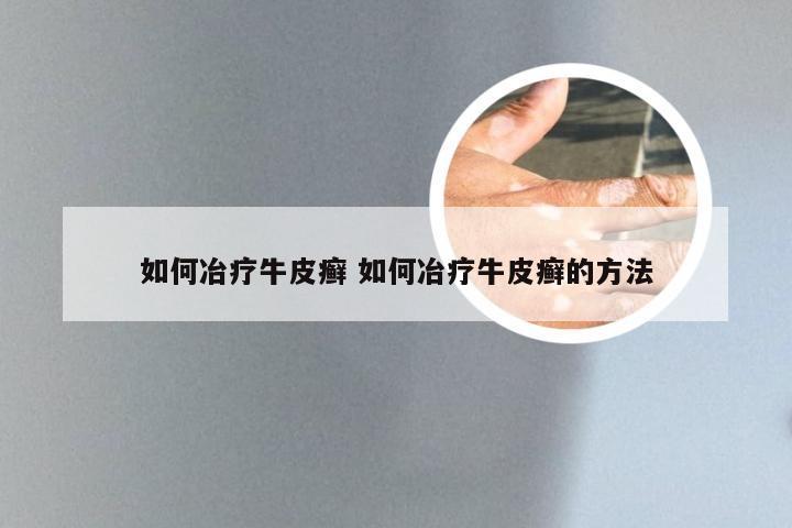 如何冶疗牛皮癣 如何冶疗牛皮癣的方法