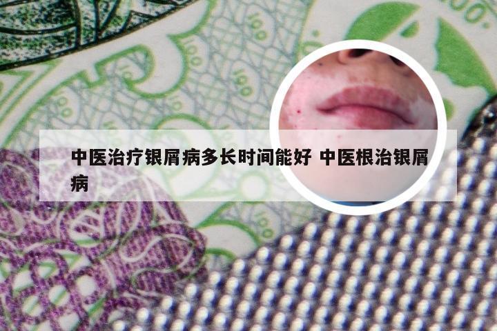 中医治疗银屑病多长时间能好 中医根治银屑病