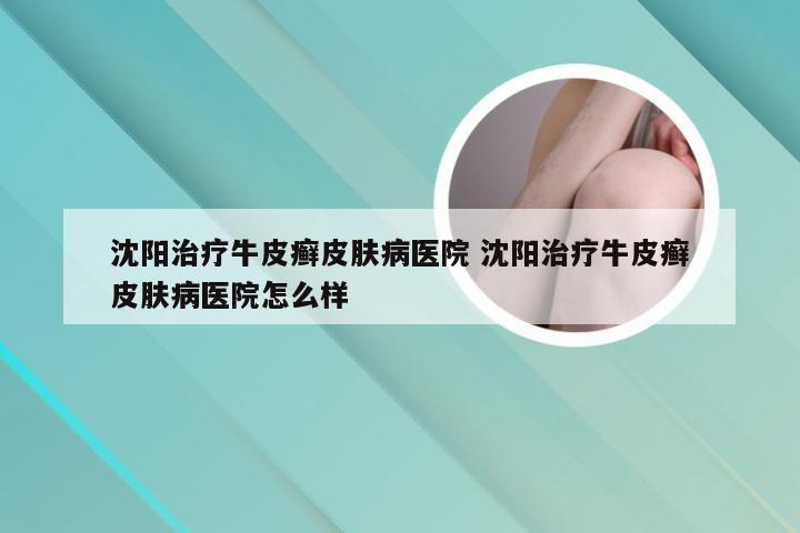 沈阳治疗牛皮癣皮肤病医院 沈阳治疗牛皮癣皮肤病医院怎么样