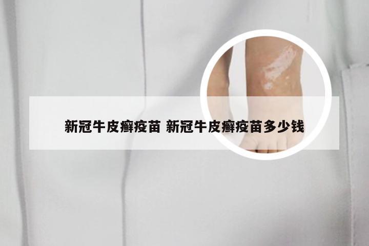新冠牛皮癣疫苗 新冠牛皮癣疫苗多少钱