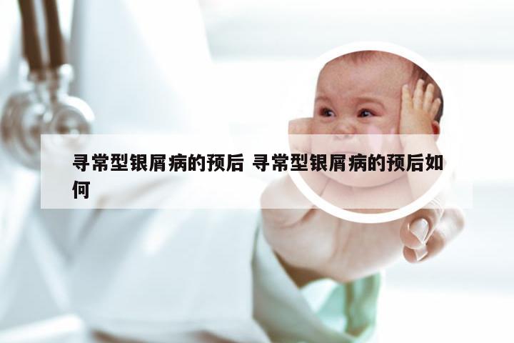 寻常型银屑病的预后 寻常型银屑病的预后如何