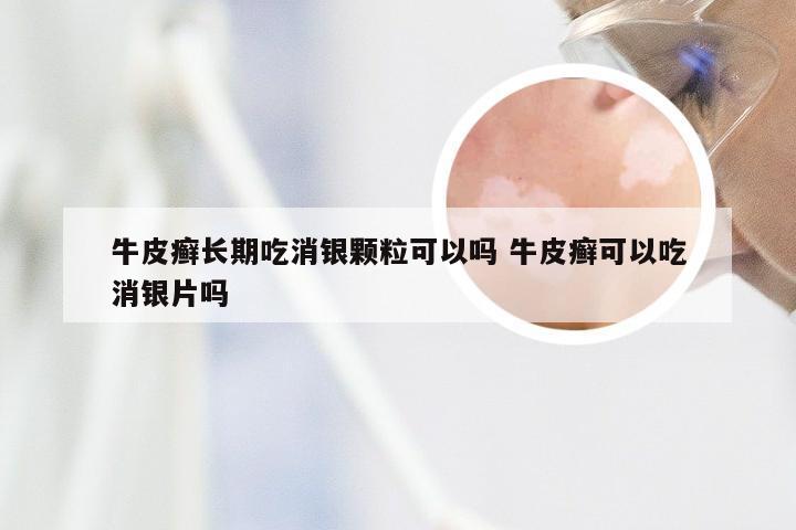 牛皮癣长期吃消银颗粒可以吗 牛皮癣可以吃消银片吗