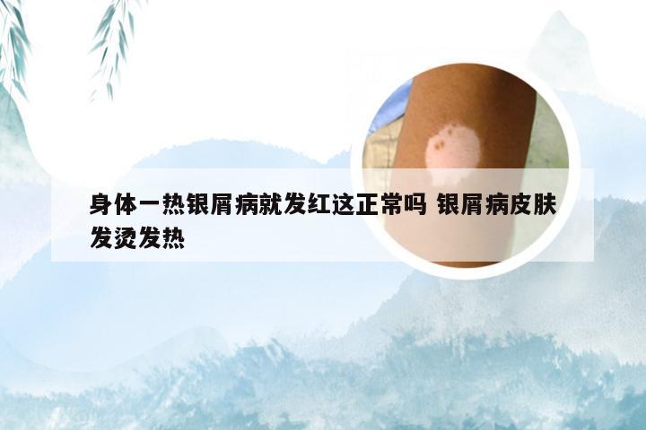 身体一热银屑病就发红这正常吗 银屑病皮肤发烫发热