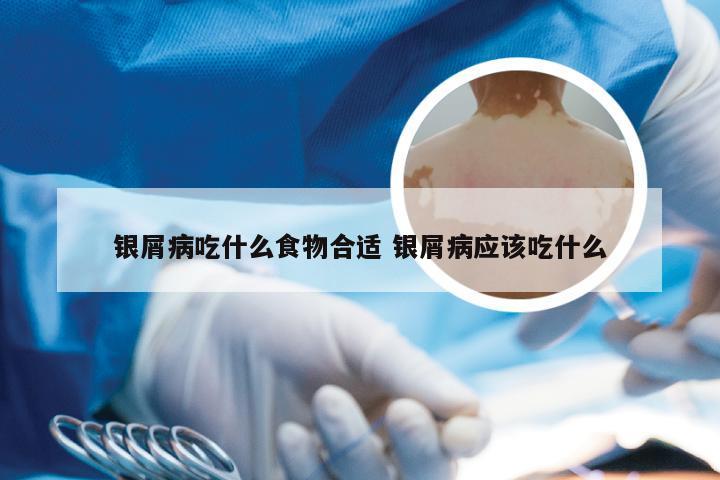 银屑病吃什么食物合适 银屑病应该吃什么