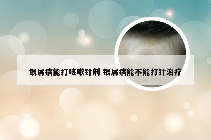 银屑病能打咳嗽针剂 银屑病能不能打针治疗