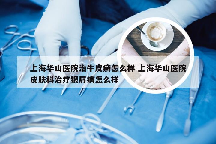 上海华山医院治牛皮癣怎么样 上海华山医院皮肤科治疗银屑病怎么样