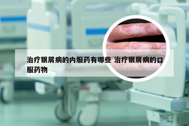 治疗银屑病的内服药有哪些 治疗银屑病的口服药物