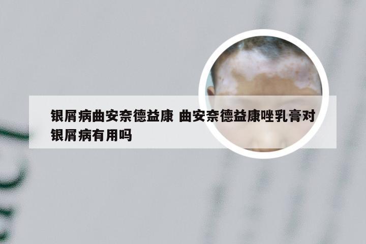 银屑病曲安奈德益康 曲安奈德益康唑乳膏对银屑病有用吗