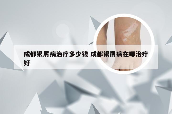 成都银屑病治疗多少钱 成都银屑病在哪治疗好