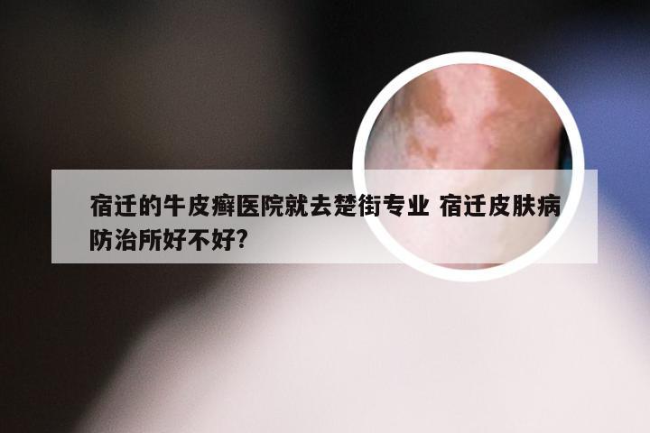 宿迁的牛皮癣医院就去楚街专业 宿迁皮肤病防治所好不好?