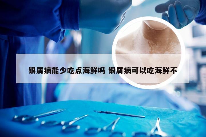 银屑病能少吃点海鲜吗 银屑病可以吃海鲜不