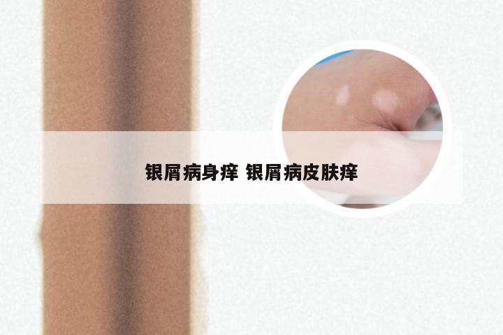 银屑病身痒 银屑病皮肤痒