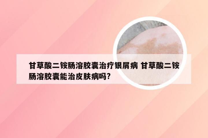 甘草酸二铵肠溶胶囊治疗银屑病 甘草酸二铵肠溶胶囊能治皮肤病吗?
