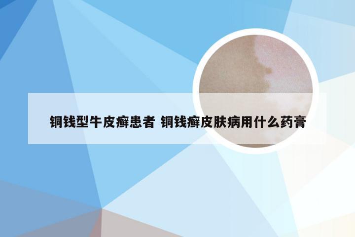 铜钱型牛皮癣患者 铜钱癣皮肤病用什么药膏